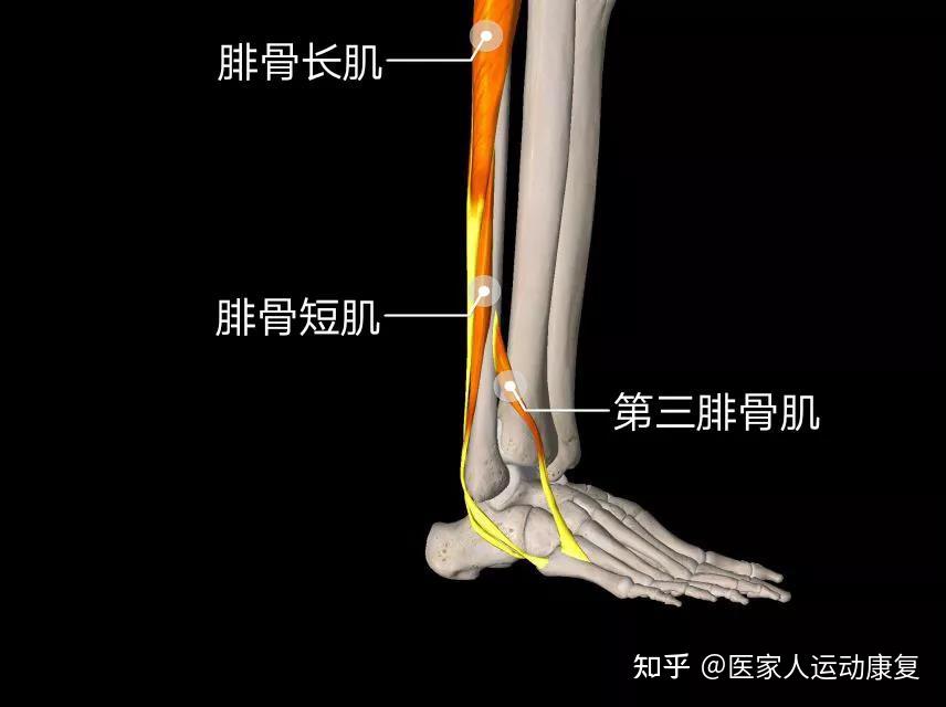 脚踝做动作时外侧会出现 弹响,随后到医院诊断为 腓骨长/短肌肌腱滑脱