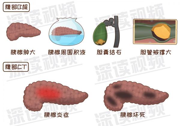 所以, 急性胰腺炎的治疗思想主要是抑制胰液分泌,消除病因以及缓解