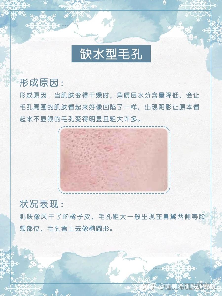状况表现:t字位的毛孔特别粗大,并布满黑头或米白色的圆形孔状粉刺.