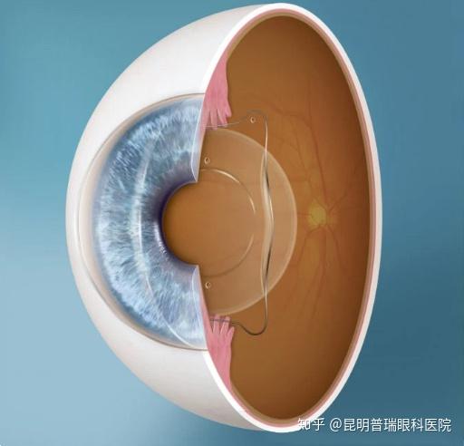 icl人工晶体植入术是通过在眼内植入一枚特殊的"隐形眼镜",从而达到