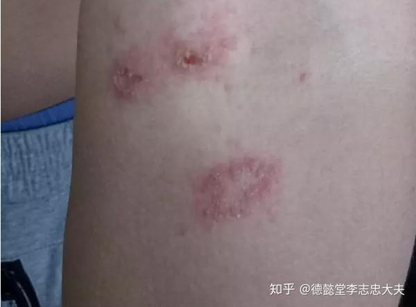是萝卜排骨?中西医v萝卜?干玫瑰干炖糠疹治咳嗽图片