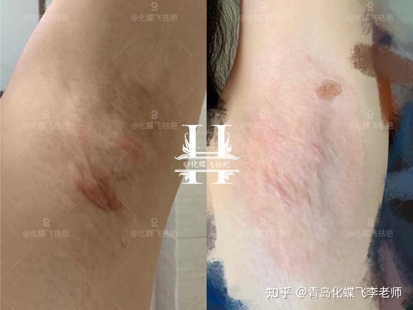 四川美女的腋下手术疤痕