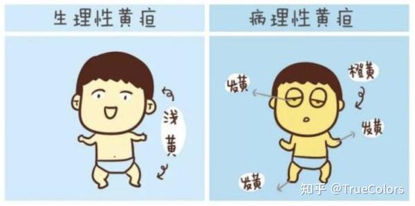 肝炎患者会因为胆红素浓度过高而产生病理性黄疸