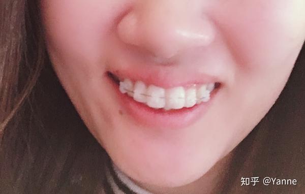 牙齿矫正--28岁半钢牙妹初体验