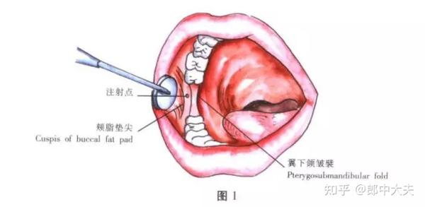 口腔医学—颌面外科常用麻醉方法图谱