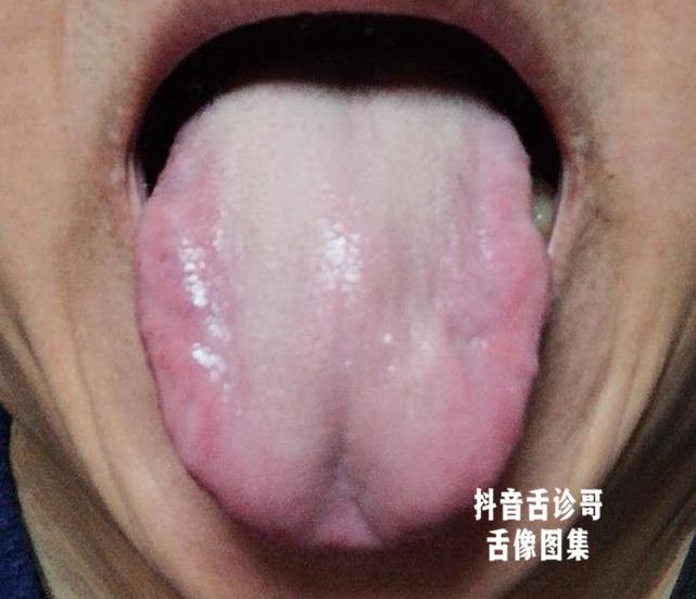 抖音舌诊哥:舌诊知健康,教你学会看舌象系列五十五