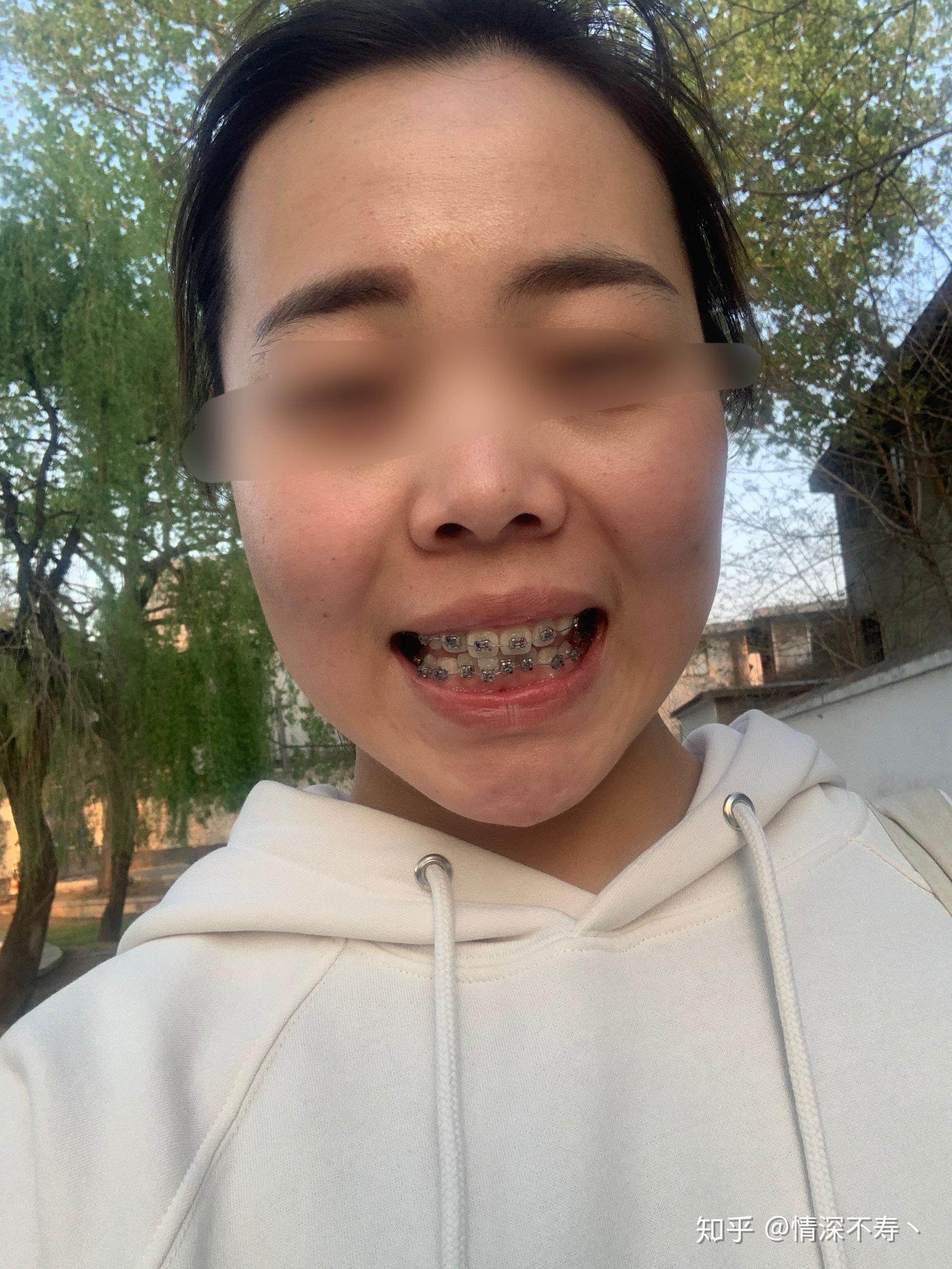 2020年3月份我决定整牙啦