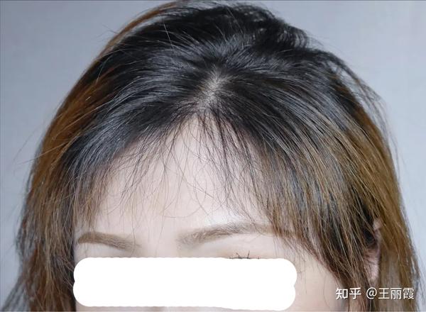 严重脱发怎么办,米诺地尔是真的可以治脱发吗?(附带参考案例)