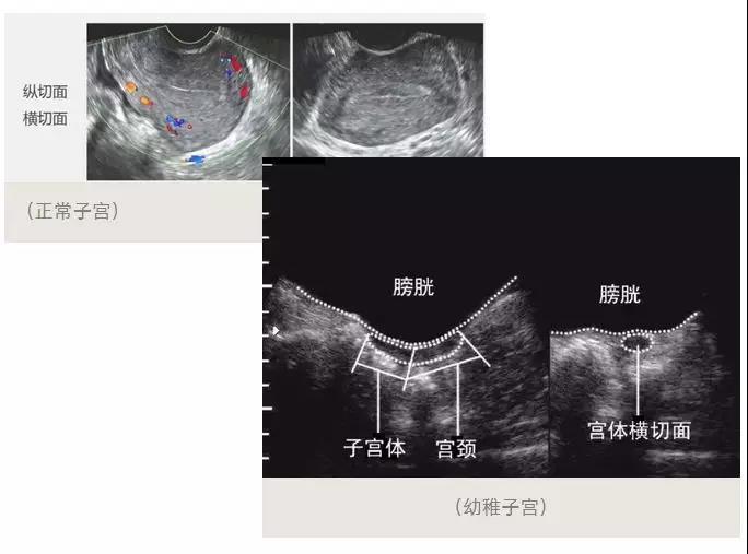 幼稚子宫其实指的就是患有此病的女性子宫跟正常女性的子宫大小有