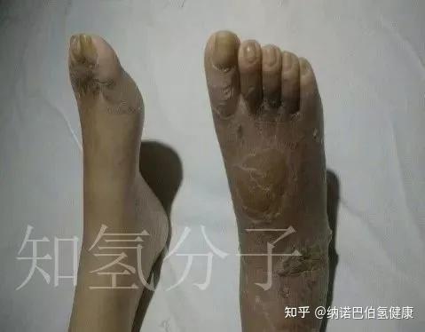 糖尿病足,氢干预有效吗?