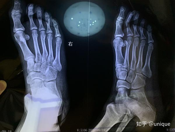 右脚第三跖骨骨折 看看这咋样啊 多久能好啊 严重不