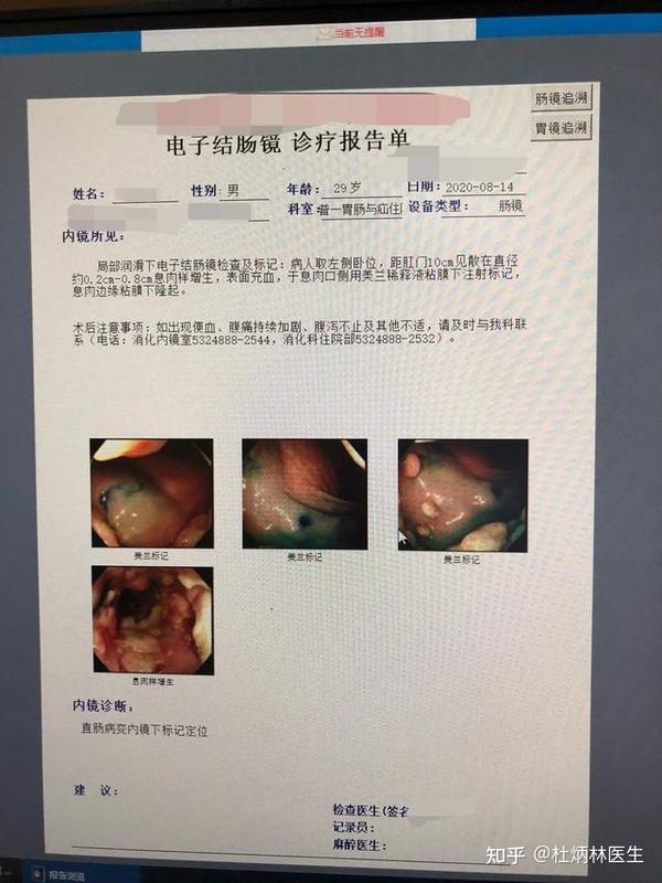 29岁男性肛周脓肿1周行肛周脓肿切开引流术