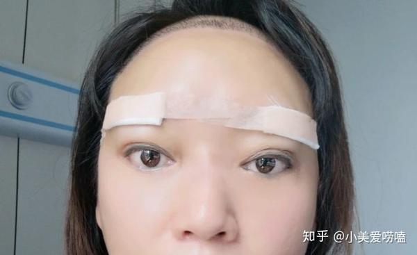 做完提眉术后几天消肿,多久可以恢复自然?不吹不黑