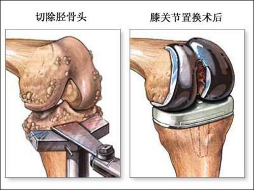 膝关节置换