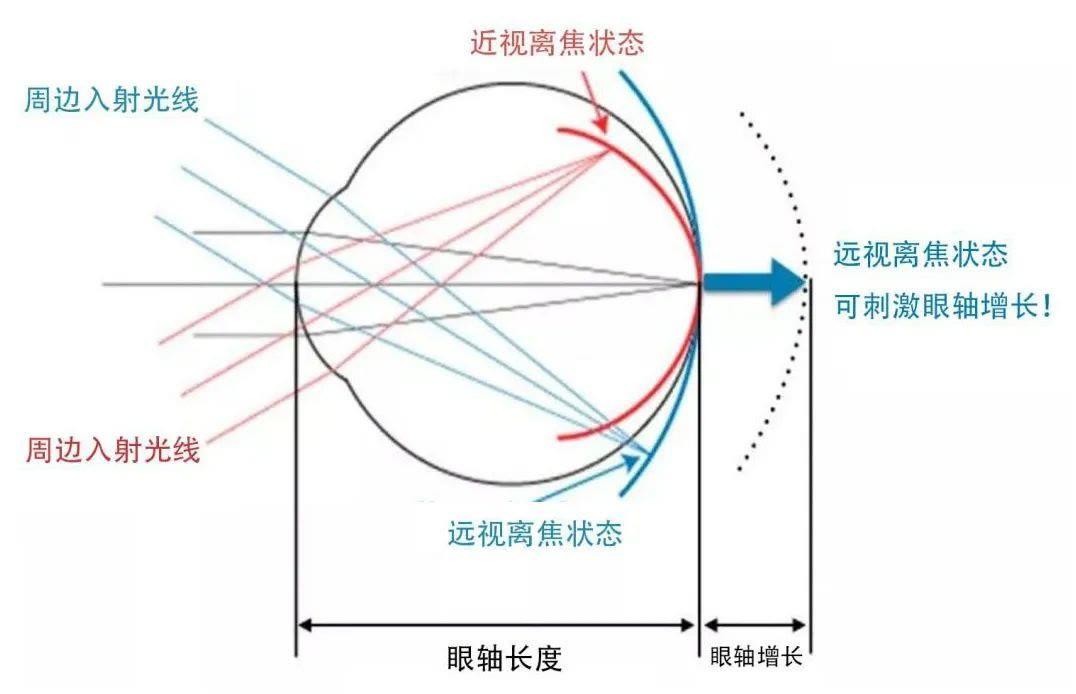 太全了近视发生的7个机制光哺乐哺光仪科普系列