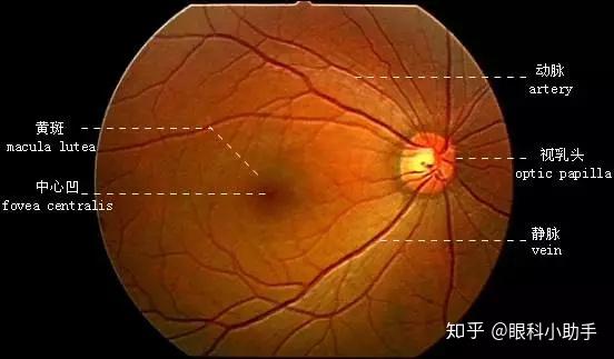 眼睛有这个情况,当心黄斑裂孔!