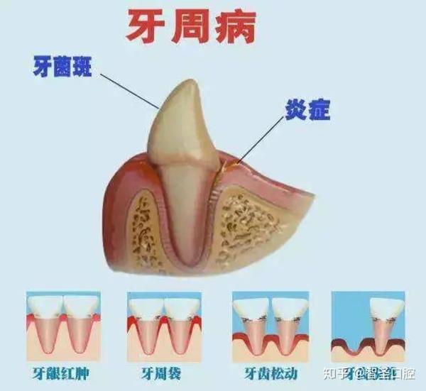 所以,有严重牙周病的患者不要一拖再拖,牙周袋越来越深,绝对不是好好