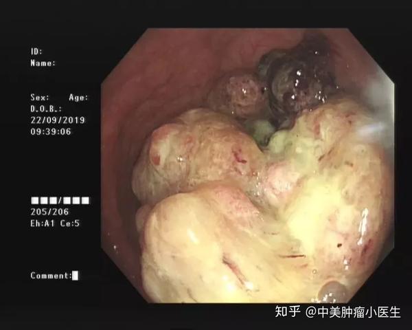 我一直以为是肠炎而医生却诊断为结肠癌