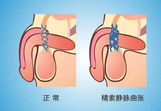 了该文章 男性私处是个疾病高发地,其中精索静脉曲张严重影响男性生育