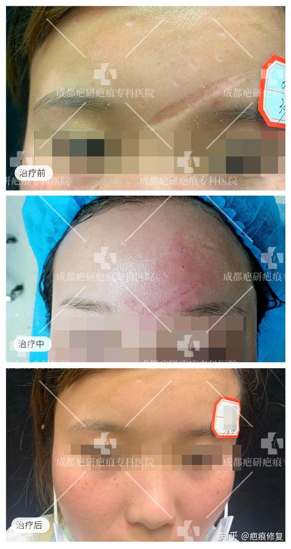 痤疮,手术,外伤,感染,水痘及天花等是常见的引起凹陷性疤痕原因,这些