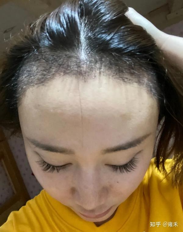 发际线后移怎么办?