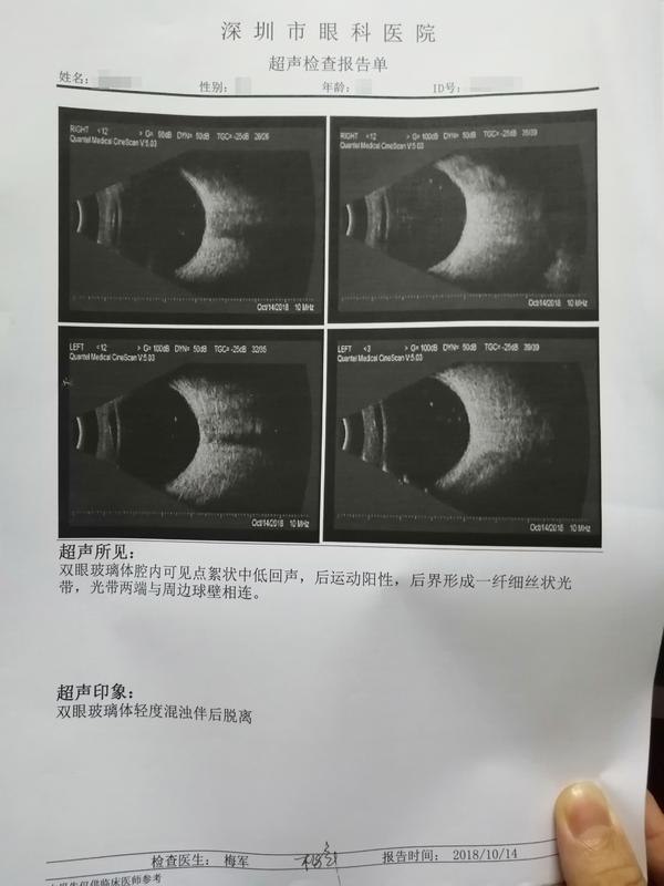 而有飞蚊症的朋友,一般会伴随着玻璃体后脱离,建议少做剧烈运动