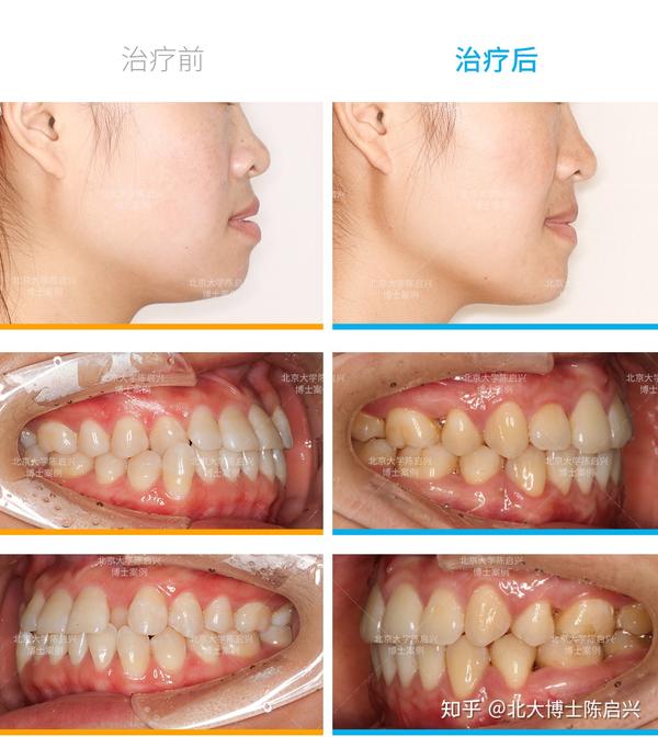 牙齿矫正案例上唇凹陷牙列不齐