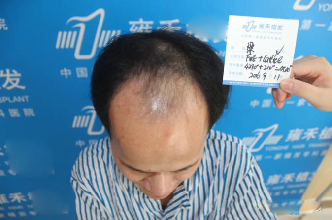 雄激素性脱发 zhuanlan.zhihu.com