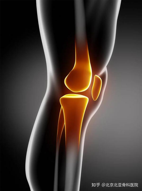 人工膝关节置换治疗膝关节骨性关节炎!