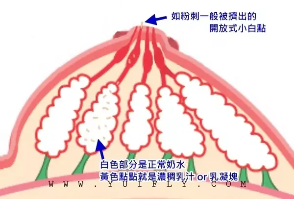 小白点又分为开放式和隐藏式,像开放式和闭锁式的粉刺(见图三图四).