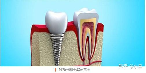 北京 上海 成都全口种植牙多少钱?镶牙和种牙哪个好?