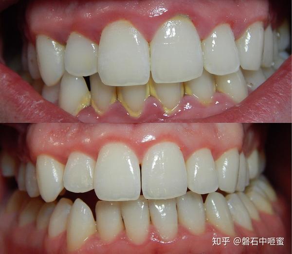 牙龈炎gingivitis