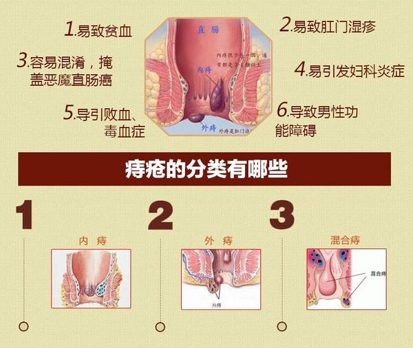 凌方殿:痔疮究竞是怎么回事?