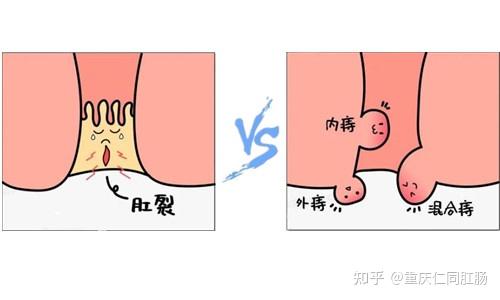 重庆仁同肛肠医院健康课堂:怎么判断是痔疮还是肛裂?