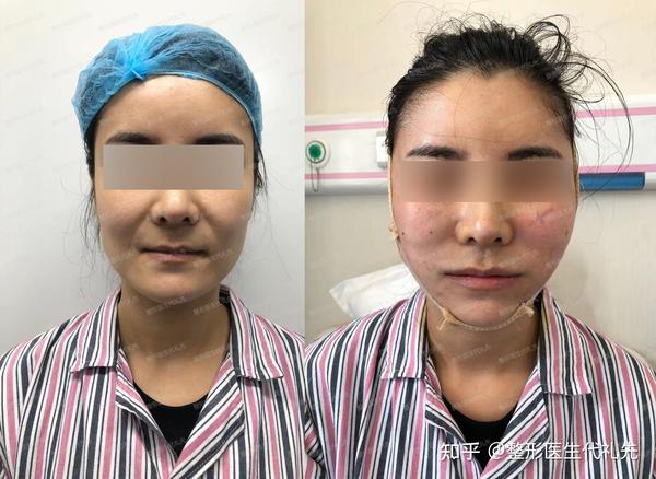北京面部提升代礼先医生谈面部年轻化-深筋膜拉皮手术能实现哪些面部