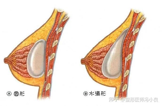 水滴形更接近人体的自身特点,但是要维持水滴的独特形状假体就要做到