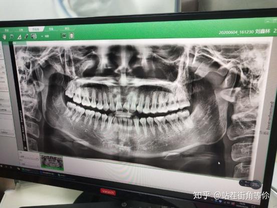 珠海牙齿矫正经历干货分享——不想丑一辈子