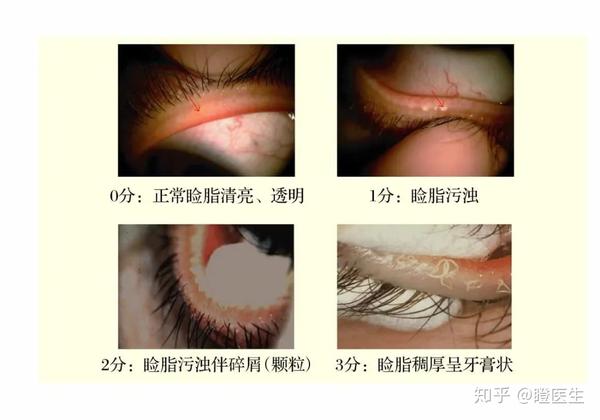 浙江省眼科医院之江院区,干眼症福利