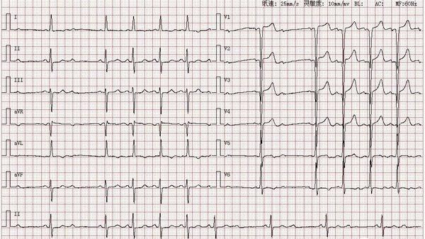 心电图图库丨二度ii型21房室传导阻滞系列