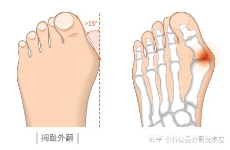 由于孩子腿部和踝关节的力量不足或者扁平足等问题,导致足内旋,足外旋