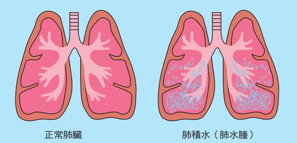 肺积水在饮食上有什么忌口吗 李中伟?