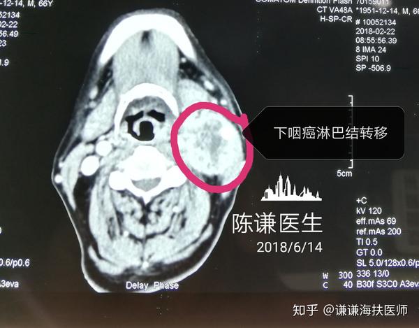 商某某下咽癌颈部淋巴结转移海扶手术病历分享