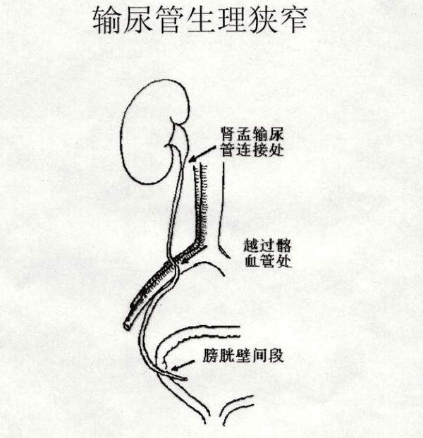 输尿管有三处解剖狭窄:第一处在肾盂与输尿管移行处;第二在跨越髂动脉
