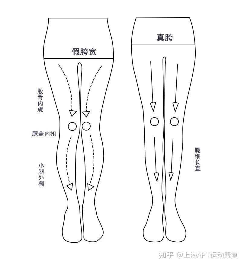 假胯宽形成的原因是什么?