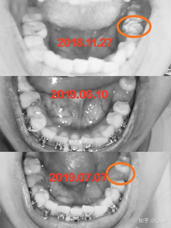 箍牙800天,毕业啦开心爆表(纯记录贴,黑照放送,慎入)