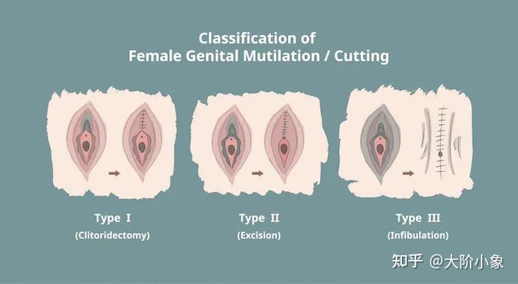 女性割礼后痊愈图片
