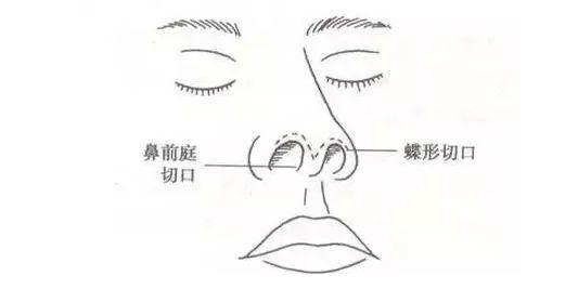 鼻综合整形改善部位:从鼻梁,鼻尖,鼻翼,鼻孔,鼻小柱等进行全鼻综合