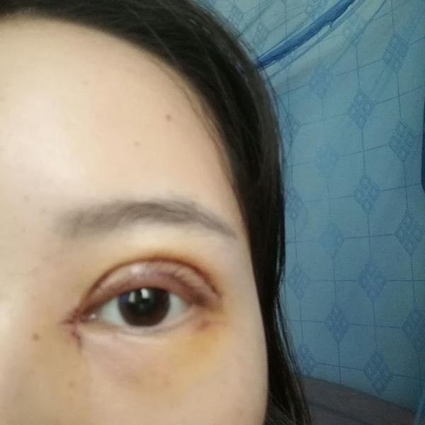 有割完双眼皮上眼睑外翻的现象的吗?能恢复吗?