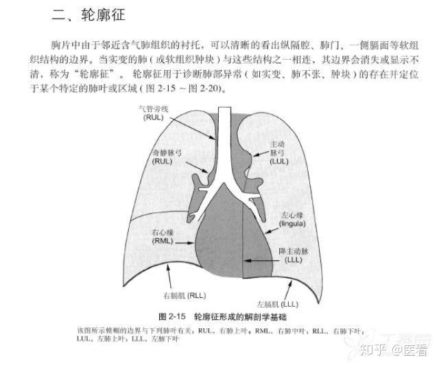 教科书上也很少见这么经典的胸片(附:肺实变的轮廓征图)