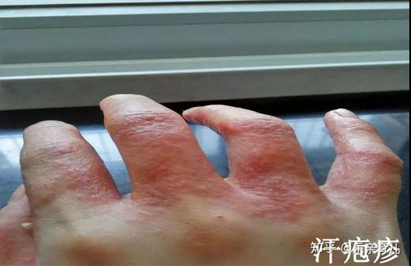 汗疱疹了解一下!